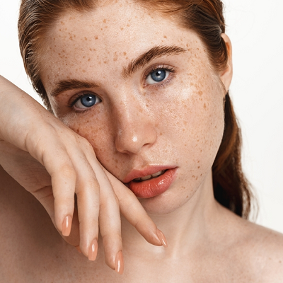 Freckles Treatment