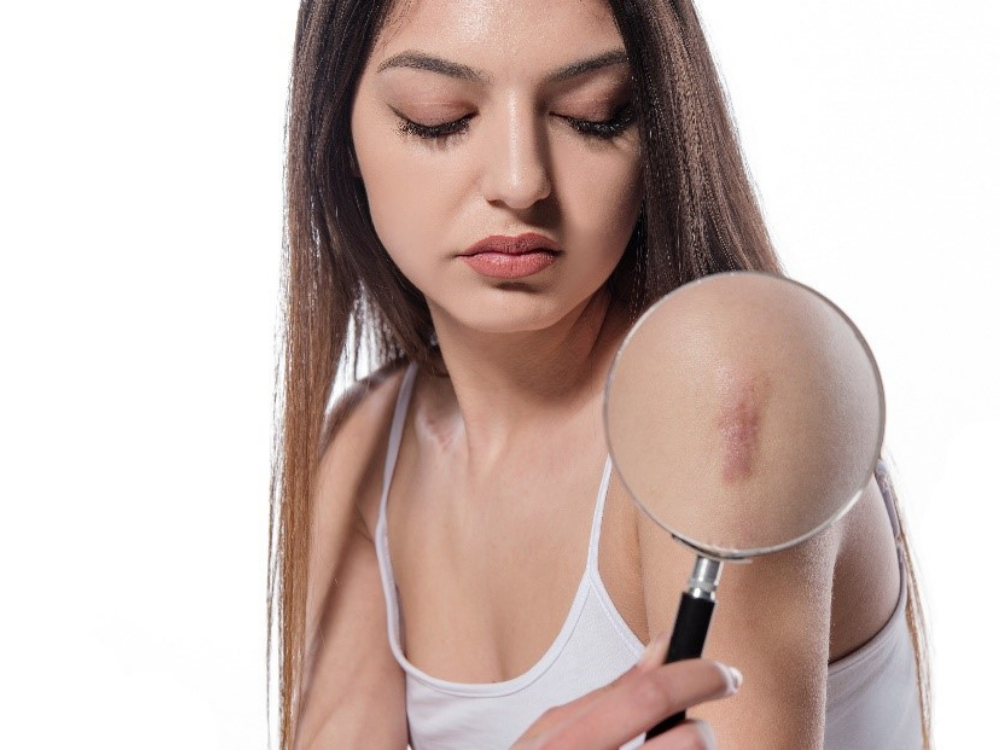 Keloids Reduction