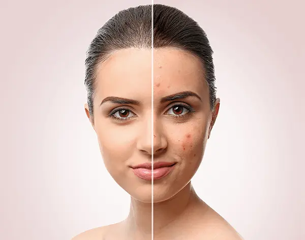 Scars Treatment