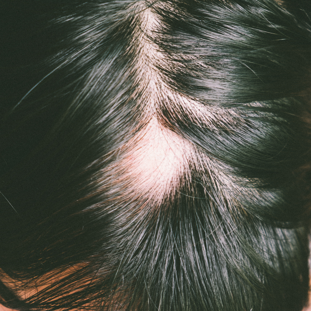 hairloss