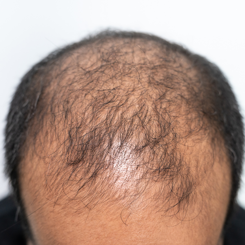 hairloss
